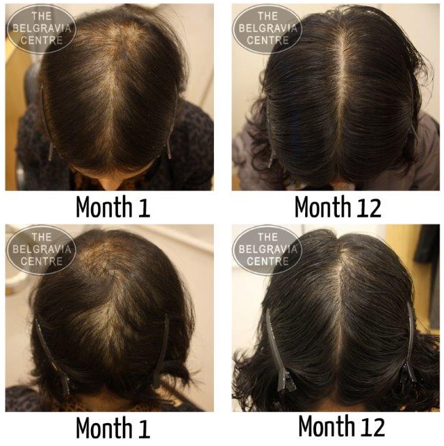 سرم فیتو ضد ریزش مدل فیتوسیان بانوان 87 درصد PHYTO PHYTOCYANE ANTI-HAIR LOSS VIAL SERUM FOR WOMEN 87%